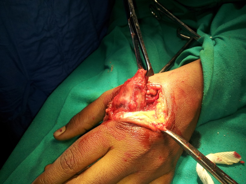 Giant cell tumor of tendon sheath under low power (10X, H/E) :shows an admixture of polygonal and spindle shaped mononuclear cells, xanthoma cells, multinucleated gaint cells in a collagenous, variably hyalinised stroma was seen .